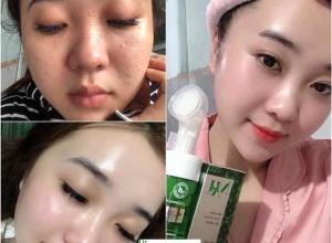  feedback trị mụn sau khi sử dụng sản phẩm Dr.Mai tại hệ thống https://drmaichinhhang.vn/