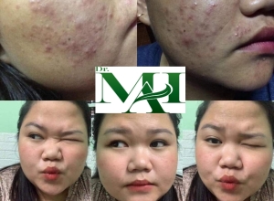  feedback trị mụn sau khi sử dụng sản phẩm Dr.Mai tại hệ thống https://drmaichinhhang.vn/