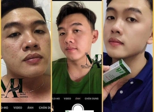  feedback trị mụn sau khi sử dụng sản phẩm Dr.Mai tại hệ thống https://drmaichinhhang.vn/