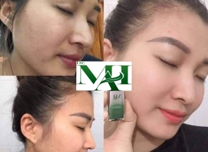  feedback trị mụn sau khi sử dụng sản phẩm Dr.Mai tại hệ thống https://drmaichinhhang.vn/