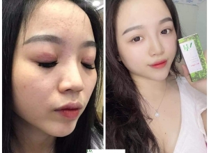  feedback trị mụn sau khi sử dụng sản phẩm Dr.Mai tại hệ thống https://drmaichinhhang.vn/