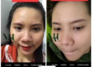  feedback trị mụn sau khi sử dụng sản phẩm Dr.Mai tại hệ thống https://drmaichinhhang.vn/