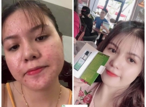  feedback trị mụn sau khi sử dụng sản phẩm Dr.Mai tại hệ thống https://drmaichinhhang.vn/
