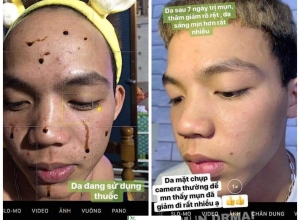  feedback trị mụn sau khi sử dụng sản phẩm Dr.Mai tại hệ thống https://drmaichinhhang.vn/