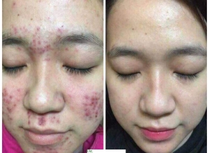  feedback trị mụn sau khi sử dụng sản phẩm Dr.Mai tại hệ thống https://drmaichinhhang.vn/