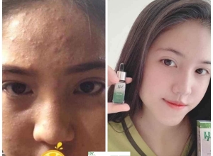  feedback trị mụn sau khi sử dụng sản phẩm Dr.Mai tại hệ thống https://drmaichinhhang.vn/