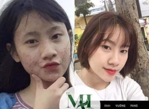  feedback trị mụn sau khi sử dụng sản phẩm Dr.Mai tại hệ thống https://drmaichinhhang.vn/