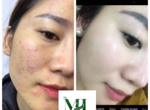  feedback trị mụn sau khi sử dụng sản phẩm Dr.Mai tại hệ thống https://drmaichinhhang.vn/