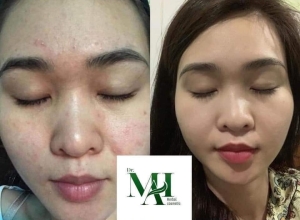  feedback trị mụn sau khi sử dụng sản phẩm Dr.Mai tại hệ thống https://drmaichinhhang.vn/