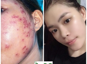  feedback trị mụn sau khi sử dụng sản phẩm Dr.Mai tại hệ thống https://drmaichinhhang.vn/