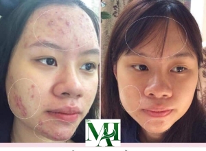  feedback trị mụn sau khi sử dụng sản phẩm Dr.Mai tại hệ thống https://drmaichinhhang.vn/