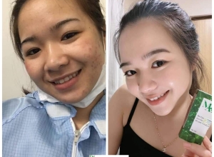  feedback trị mụn sau khi sử dụng sản phẩm Dr.Mai tại hệ thống https://drmaichinhhang.vn/