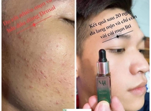  feedback trị mụn sau khi sử dụng sản phẩm Dr.Mai tại hệ thống https://drmaichinhhang.vn/