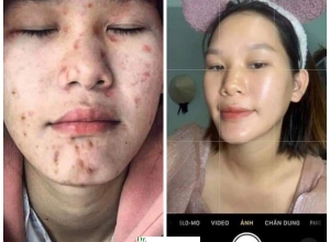  feedback trị mụn sau khi sử dụng sản phẩm Dr.Mai tại hệ thống https://drmaichinhhang.vn/