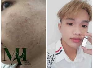  feedback trị mụn sau khi sử dụng sản phẩm Dr.Mai tại hệ thống https://drmaichinhhang.vn/