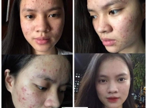  feedback trị mụn sau khi sử dụng sản phẩm Dr.Mai tại hệ thống https://drmaichinhhang.vn/