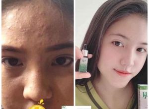  feedback trị mụn sau khi sử dụng sản phẩm Dr.Mai tại hệ thống https://drmaichinhhang.vn/